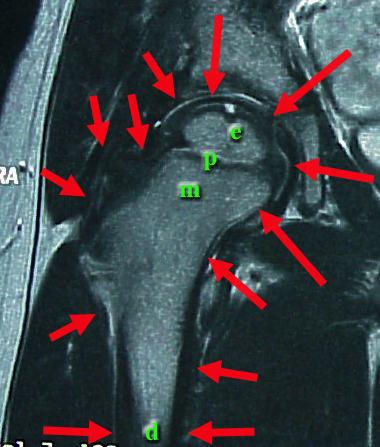 Slipped Capital Femoral Epiphysis. we see the upper femur.